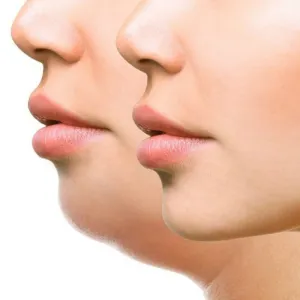 Kybella