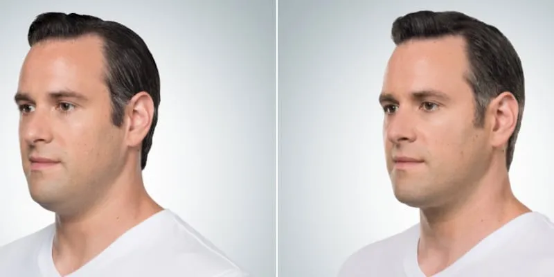 Kybella