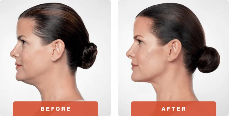 Kybella